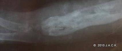 oct 2010 - right humerus oct 2010 - right sick humerus