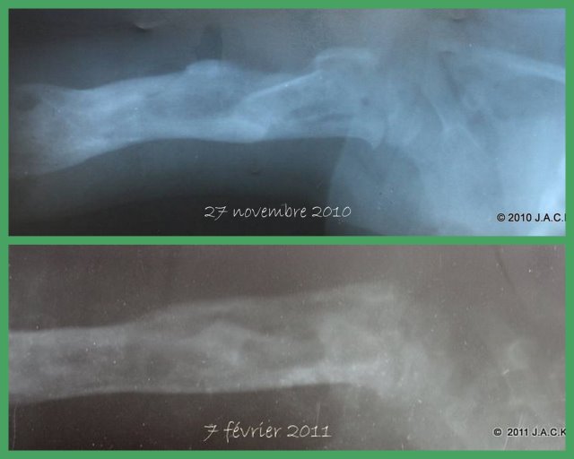 Tommy's right humerus: before & today