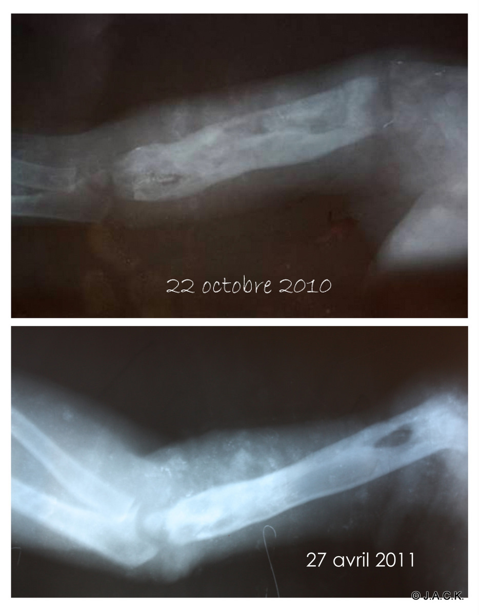 evolution of osteomyelitis Tommy's right humerus